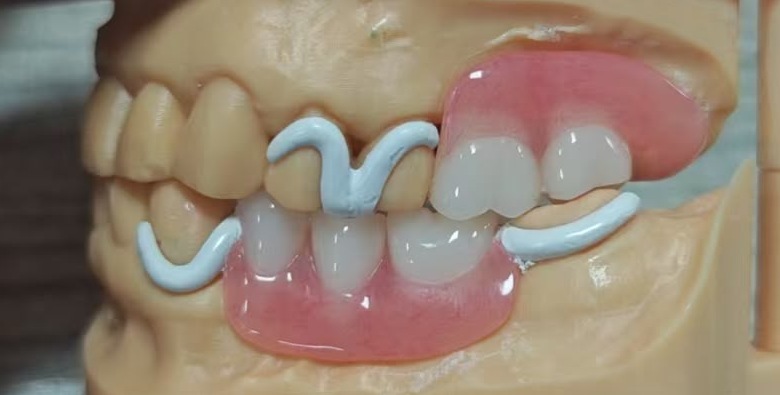 Removable framework shown from the lateral view on a working model